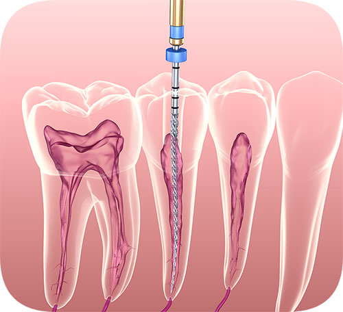 Endodontics Dentistry
