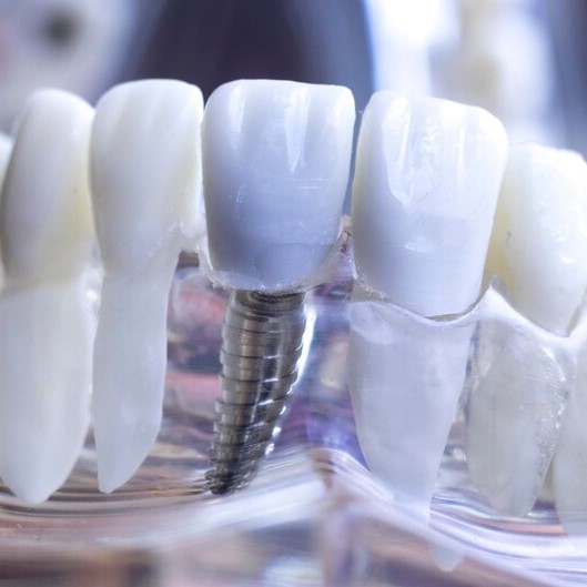 single tooth implant