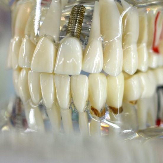 same day dental implant