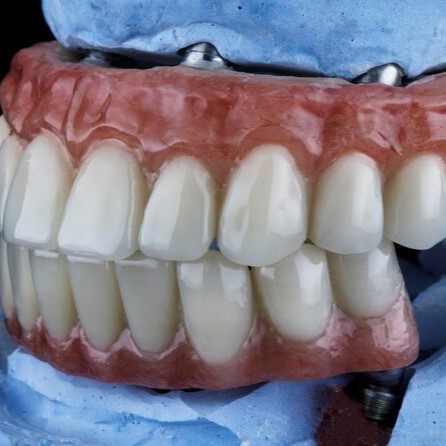 all on 4 dental implant