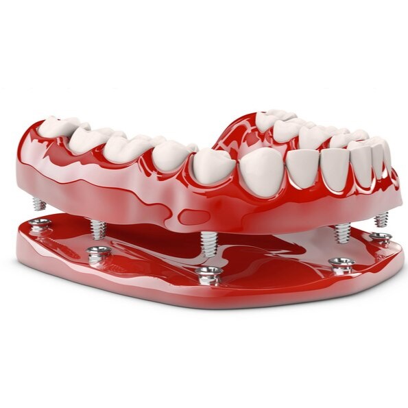 all on 6 dental implant