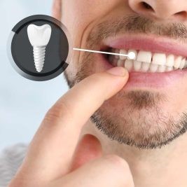 Dental Implant Image